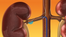 Renale Denervation (Bild: medtronic, Abdruck frei)