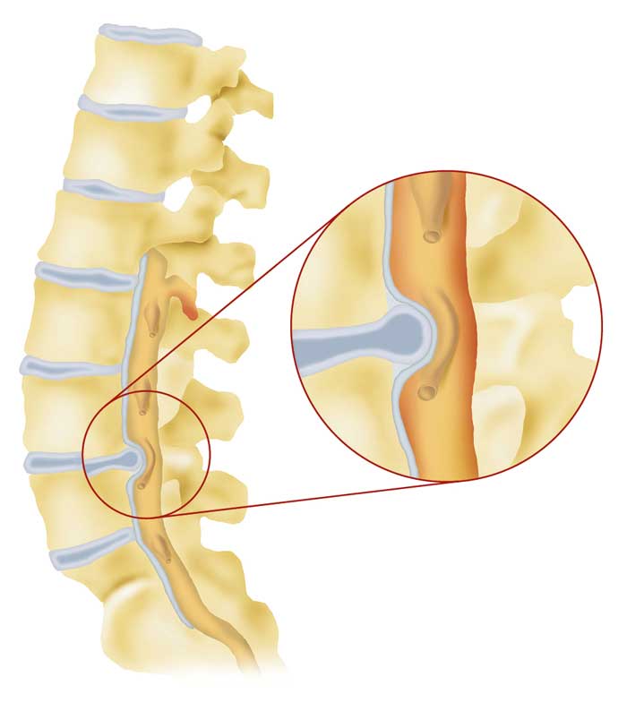 Mag24 R K Spinalkanal 01 H